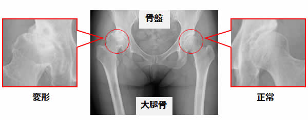 人工股関節全置換術とは