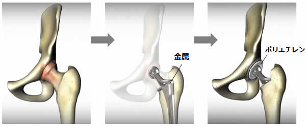 人工股関節全置換術とは