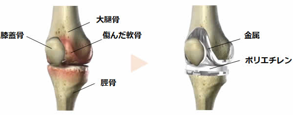人工膝関節置換術とは