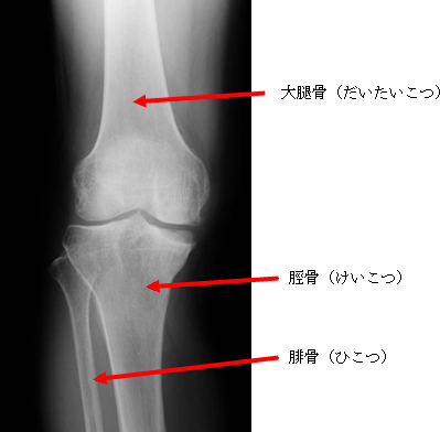 軽度の膝関節症