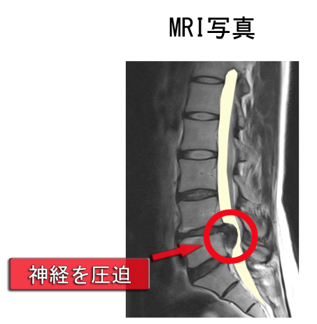 と 椎間板 は ヘルニア