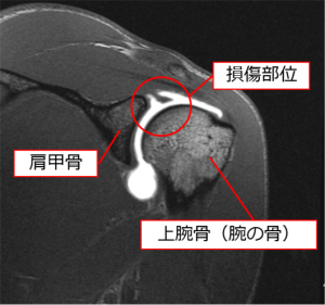 関節鏡視下肩関節唇形成術とは?