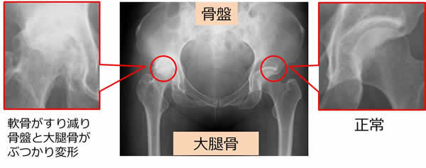 人工関節 股関節 手術 | あんしん病院