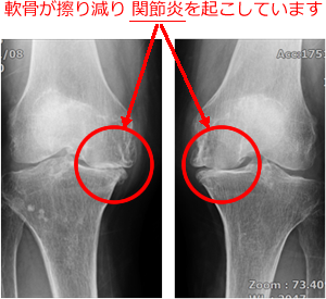人工膝関節全置換術とは