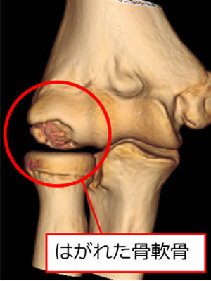 肘関節モザイクプラスティーとは